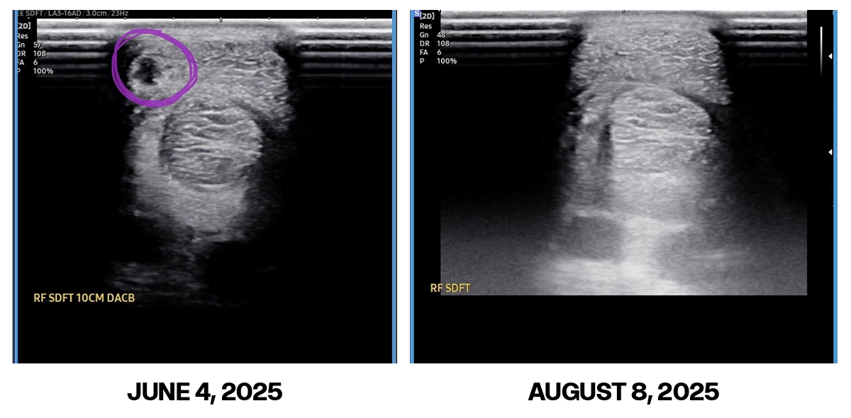 Healed grade 2.5/5 SDFT tear front leg using STJ